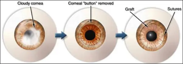 corneal grafting