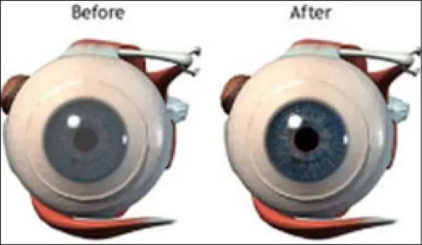 corneal grafting