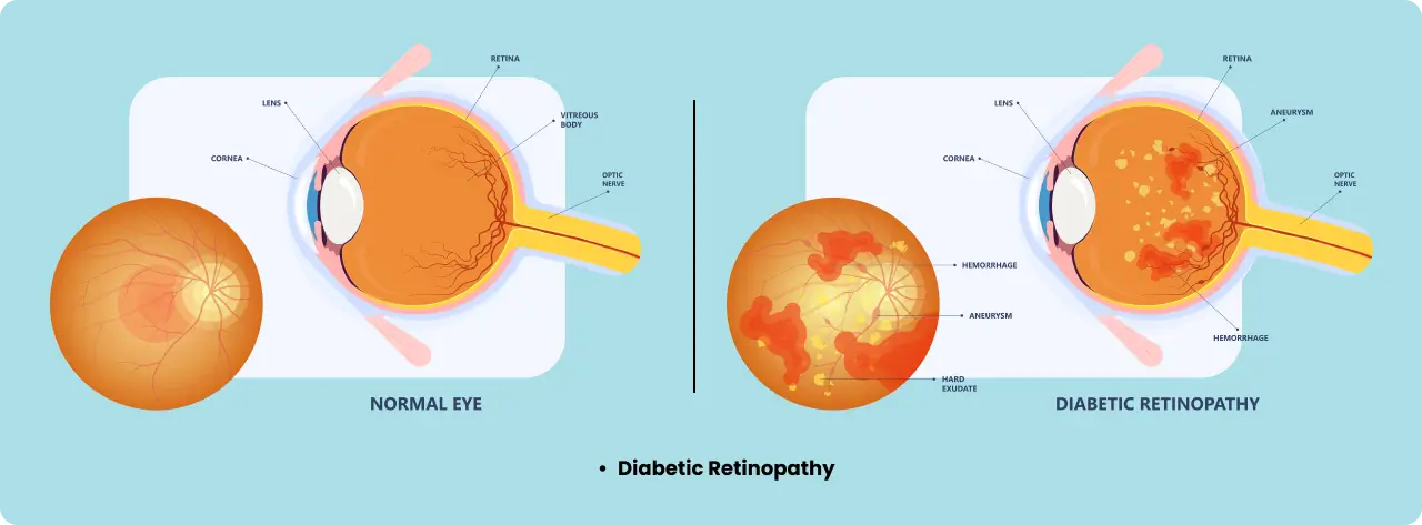 diabetic retinopathy eye