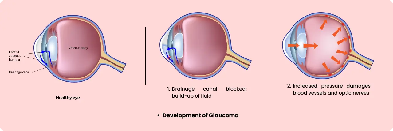 glaucoma eye