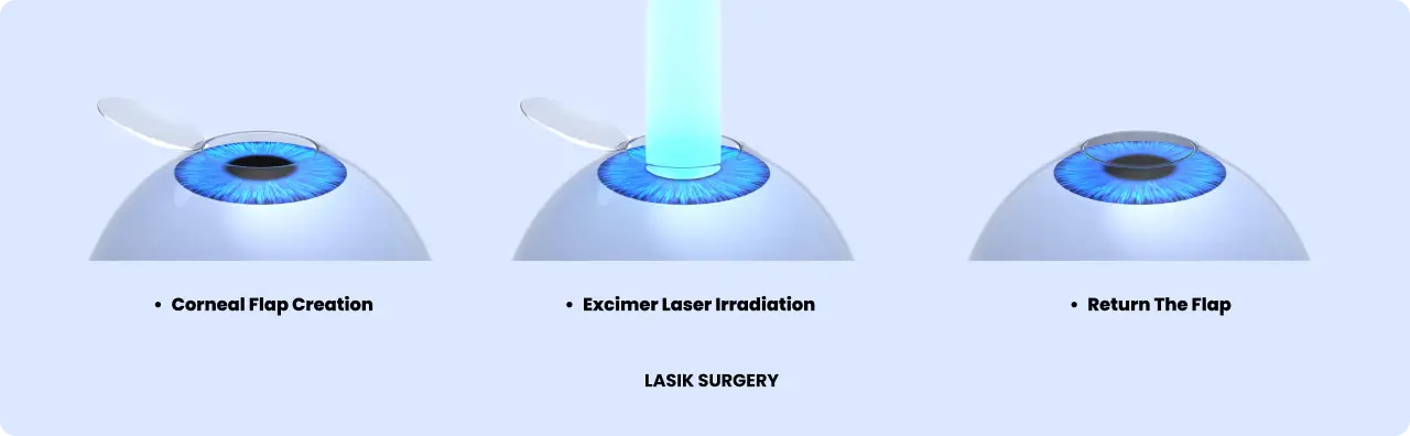 lasik eye