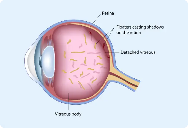 vitreous diseases