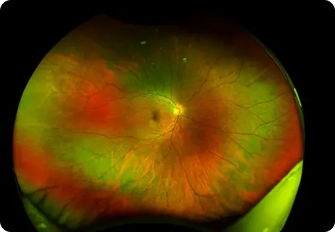 retina vitreous disorders