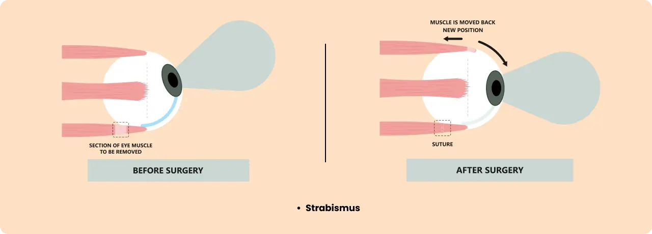 squint oculomotor disorders eye